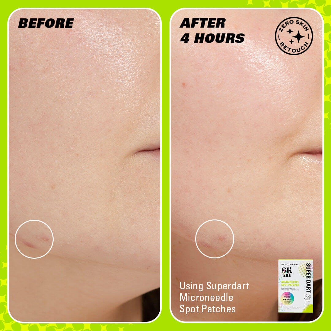 Revolution Skin Super Dart Microneedle Salicylic Acid Hydrocolloid Spot Patches