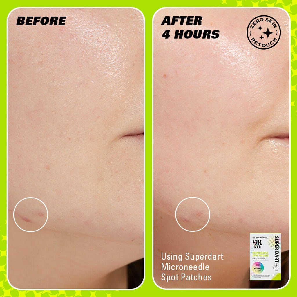 Revolution Skin Super Dart Microneedle Salicylic Acid Hydrocolloid Spot Patches